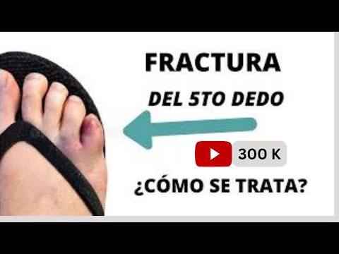 Video: Cómo emparejar con cinta adhesiva un dedo del pie lesionado: 7 pasos (con imágenes)