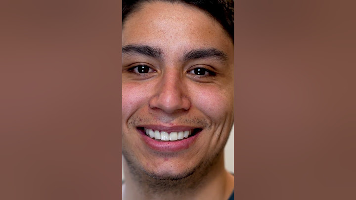 Ed’s Before and After New Smile Transformation with Porcelain Veneers