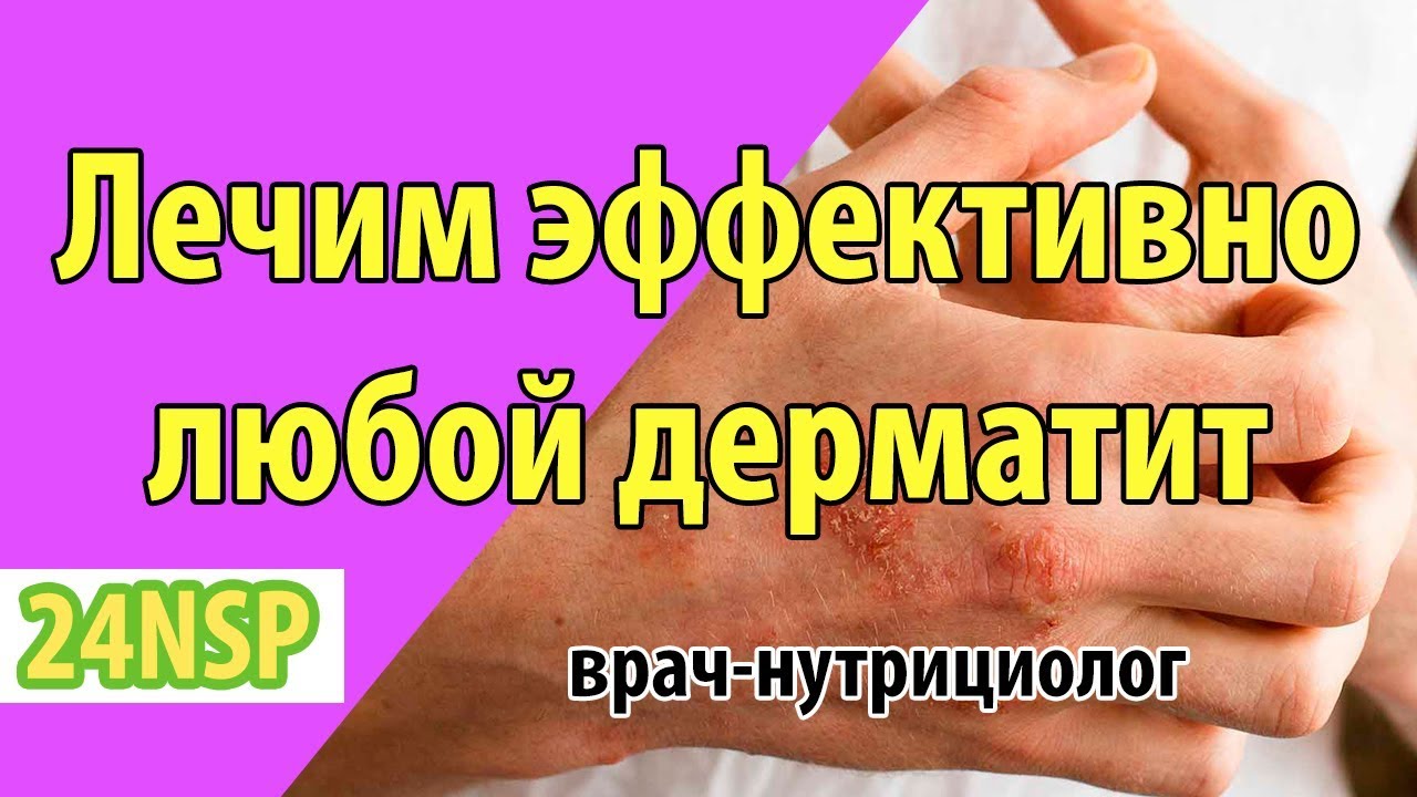 Как лечить атопический дерматит у ребенка или взрослого? Эффективное ...