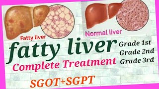 फैटी लिवर ग्रेड 1st,2nd,3rd का इलाज, 100 % सलूशनof Fatty liver, फैटी लिवर का घरेलू इलाज, फैटी लिवर ।