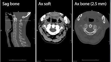 Cervical spine CT (computed tomography) radiology search pattern