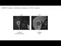 Imaging hcc and lirads