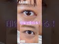 目頭切開で蒙古襞を解除！【二重整形】#shorts
