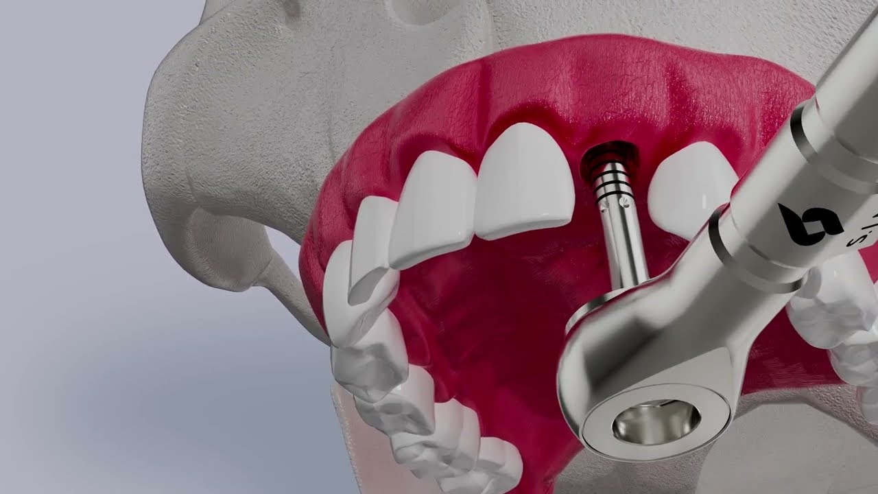 Epikut Surgical Kit (Gen 3): Drilling Sequence