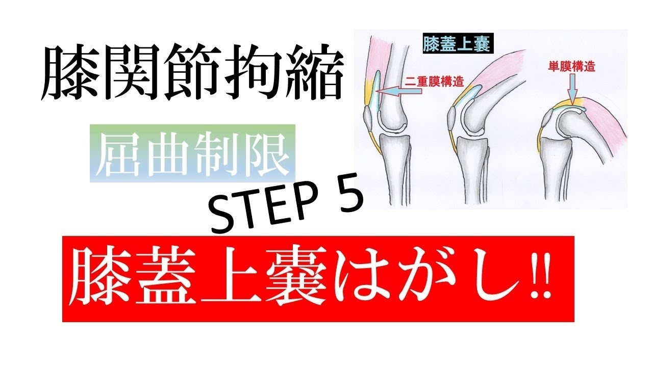 vol.22 膝関節拘縮　屈曲制限　膝蓋上嚢はがし‼　STEP 5