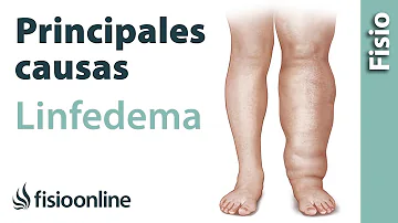 ¿Cuál es la causa principal del linfedema?