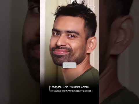 Receding Hairline in 20s? You&#39;re Not Alone. Do THIS!