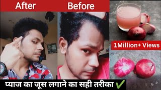How To Use Onion Juice For Hair Regrowth/ Dandruff/ Extreme Hair fall/ Premature Greying Of Hair