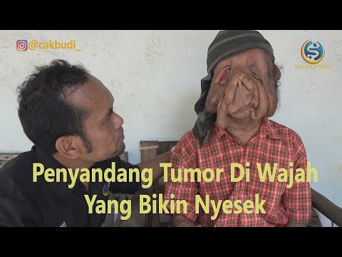 Video: Tumor Mengerikan Mencacatkan Wajah Budak Lelaki Berusia Tujuh Tahun - Pandangan Alternatif