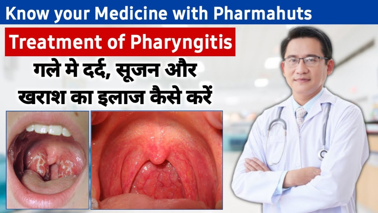 Pharyngitis throat infection treatment in hindi गले में खराश दर्द और