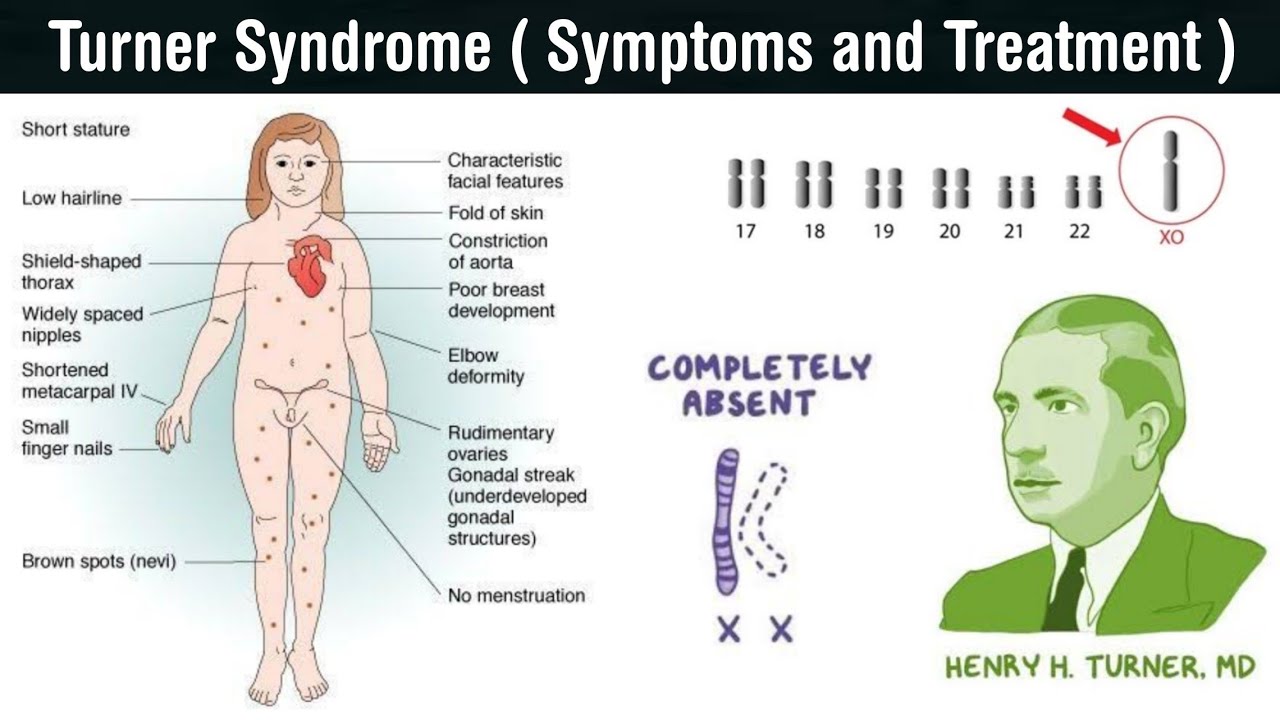 turner syndrome facts