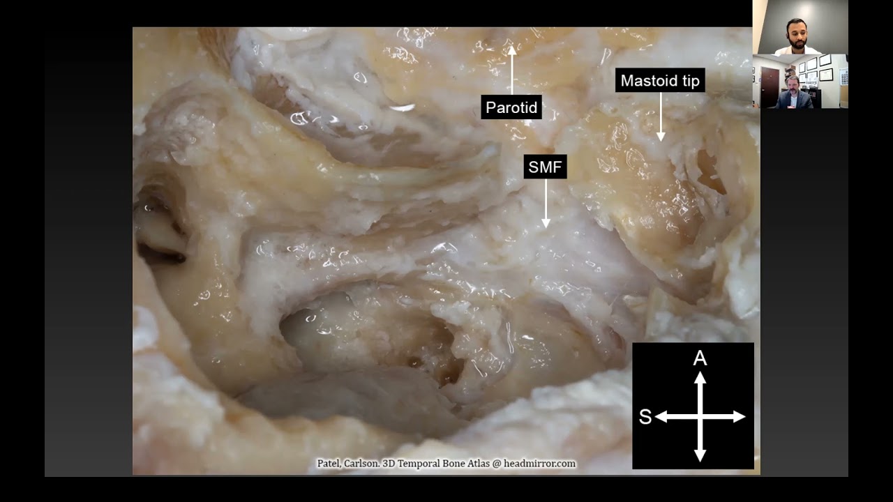 Middle Ear & Mastoid – Oto Surgery Atlas