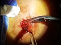 Cheek cyst squeeze  surgeon narration