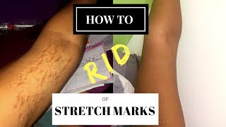 HOW TO GET RID OF STRETCH MARKS & SCARS FAST!   | #RealWednesdays