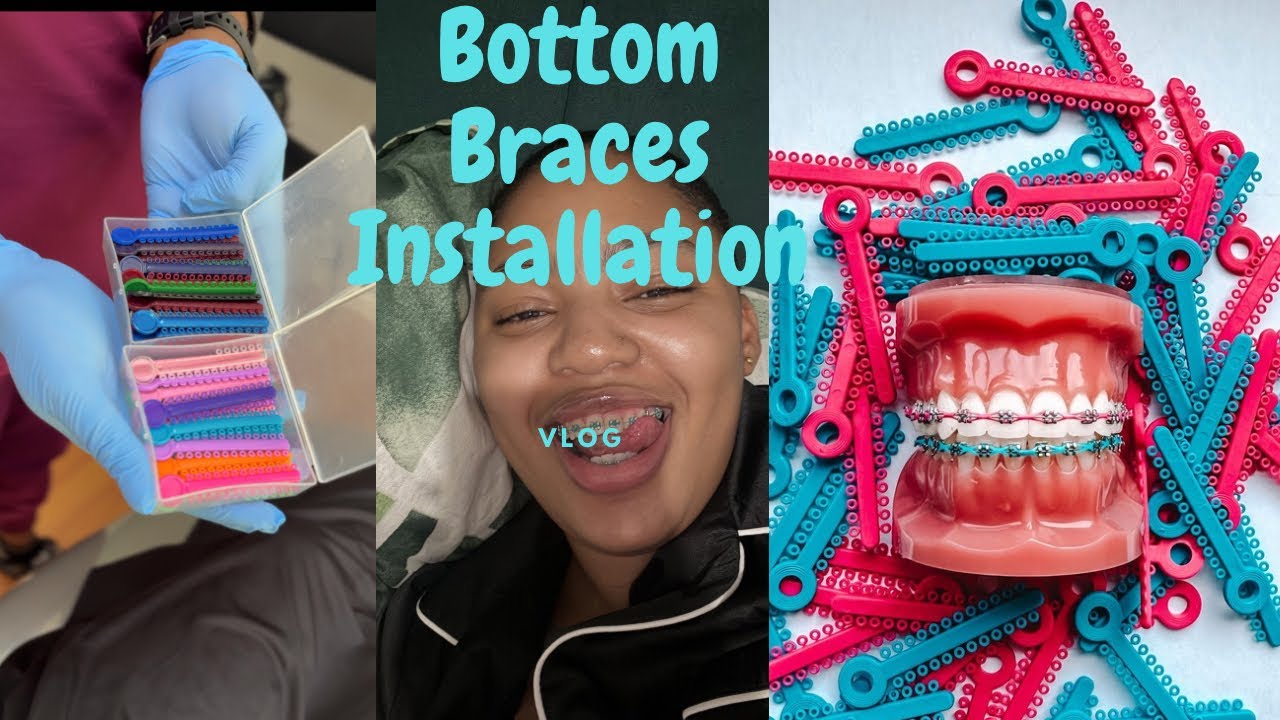 #vlog | Bottom Braces Installation | #tealover - YouTube