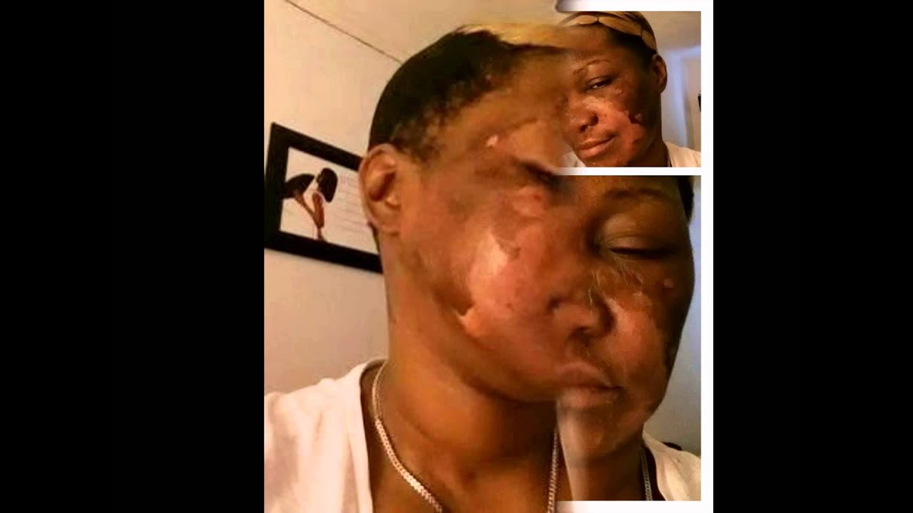 20 tca home chemical peel instructions with pictures. 20 tca home chemical peel instructions with pictures.