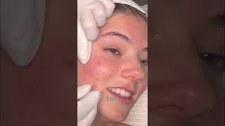Satisfying Pimple Pop: HUGE Blackhead EXPOSED! #shorts