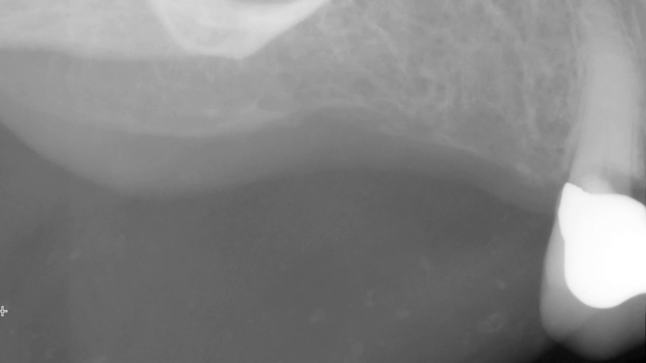 Osteoma Cutis on 2D radiographs - YouTube