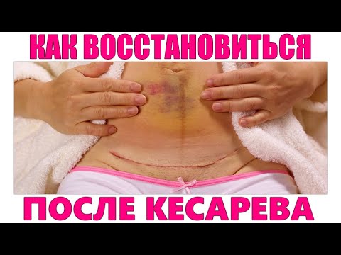 ЭТАПЫ ВОССТАНОВЛЕНИЯ ПОСЛЕ КЕСАРЕВА СЕЧЕНИЯ | Как прийти в себя после кесарева