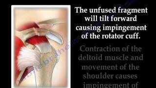 The Acromion Os Acromiale - Everything You Need To Know - Dr. Nabil Ebraheim