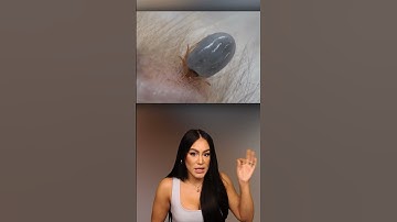 What Happens When A Tick Bites You