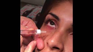 Tear Trough Filling with Restylane for UnderEye Circles / Tired Eyes | Dr. David P. Rapaport NYC