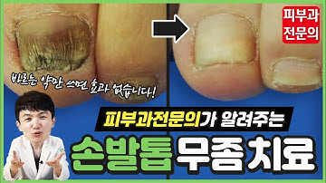 (sub)피부과전문의가 알려주는 정.확.한 손발톱무좀 치료법?(먹는약,바르는약,핀포인트레이저,루눌라레이저)