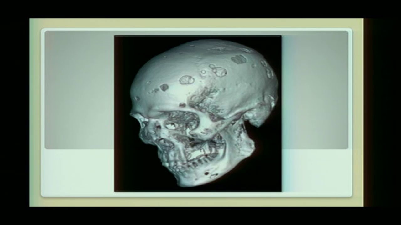 34 PET CT en tumores óseos Mieloma Múltiple - Dra. Mónica Vidal - YouTube