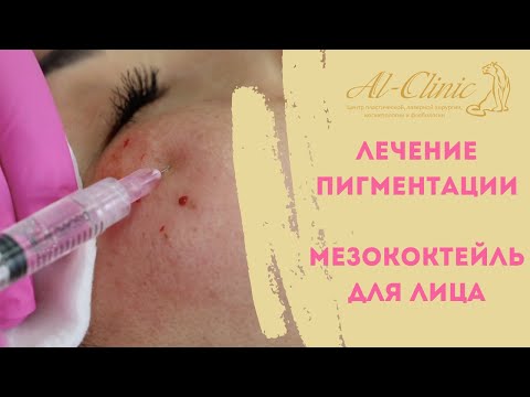 Лечение пигментации и пигментных пятен на лице. Прямой эфир с доктором Еленой Геннадьевной.