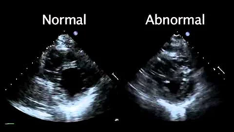 Echocardiogram from the Patient Compared with That from a Normal Control | NEJM