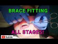 How Braces Are Put On - AMAZING! Orthodontist Explained Each Step!