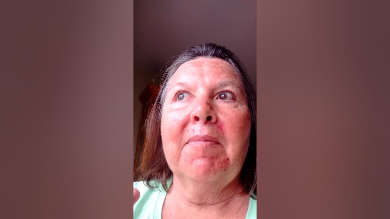 Day 2 post efudex cream after 27 days of use 2X daily YouTube