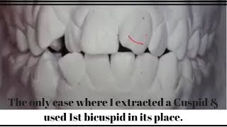 The only case where I extracted a Cuspid & used 1st  bicuspid in its place. Very Interesting Solutio