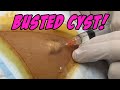 Back Cyst Busted
