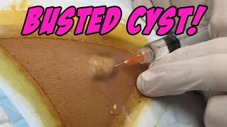 Back Cyst Busted