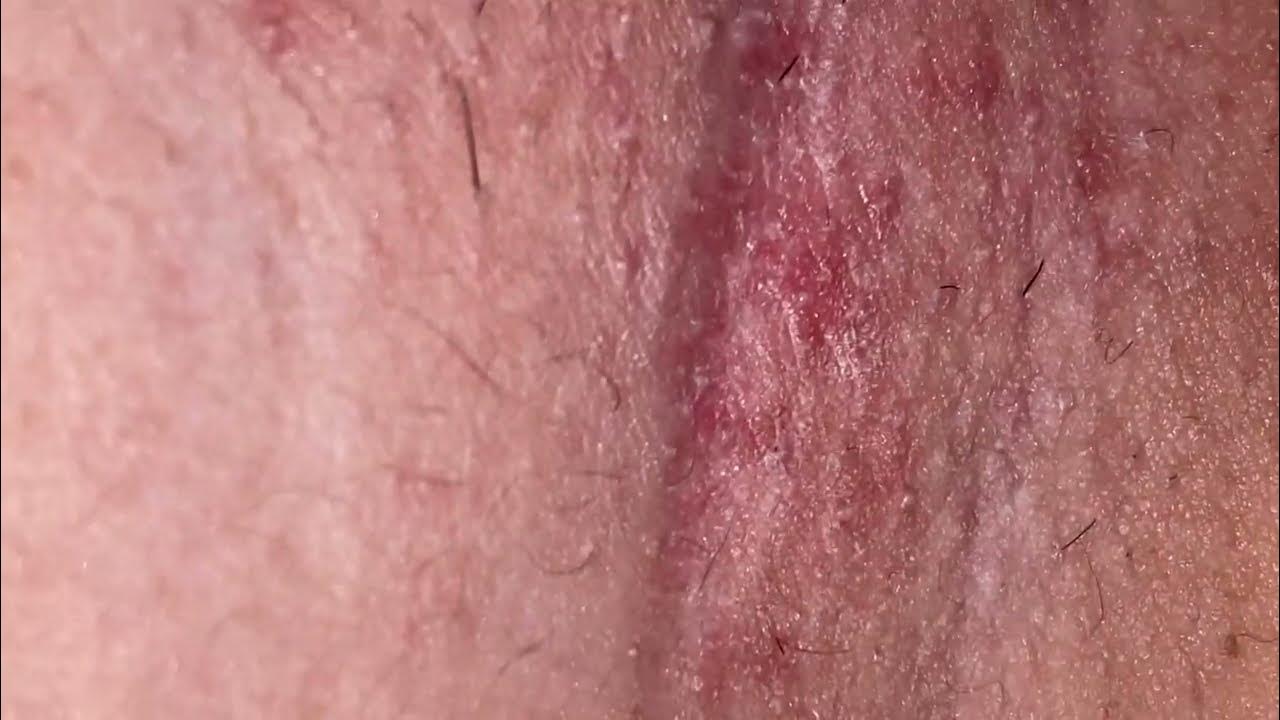 How to remove armpit hair and blackheads yourself without a doctor