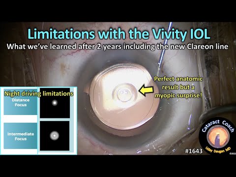 CataractCoach 1643: Limitations With The Vivity IOL (extended Depth Of Focus)