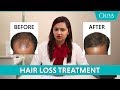 PRP Treatment For Hair Fall, Baldness & Hair Regrowth: Before, After Results