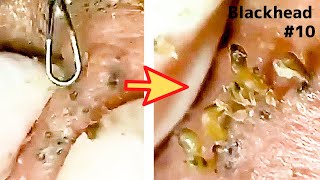 【角栓除去】グロいけど大量のニキビを芯出しするのって気持ちいい／Blackhead Removal Show