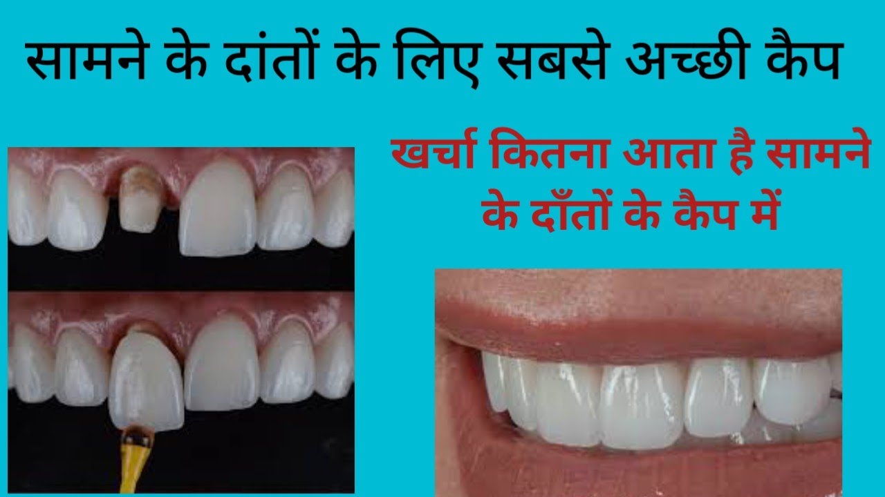 सामने के दांतों के लिए सबसे अछि कैप/कैप का खर्चा/Types of dental cap