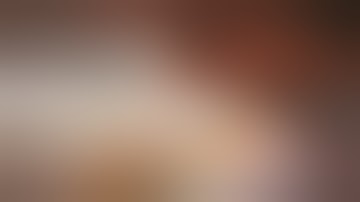 Xi Robotic Left Upper Lobectomy