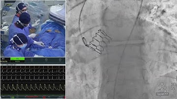 Myval THV series - Optimise patient outcomes with novel design, data and daily clinical practice
