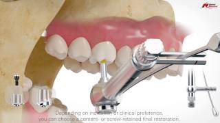 On1 concept: intraoral scanning | Nobel Biocare