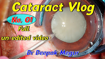 Cataract Vlog No,01 (Full Cataract surgery video) - Dr Deepak Megur