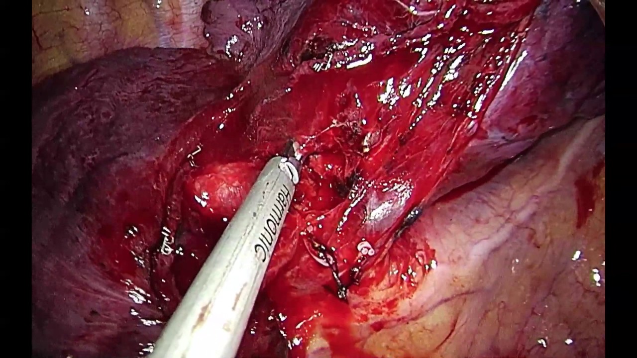 Uniportal VATS anatomic right bisegmentectomy S2+S3