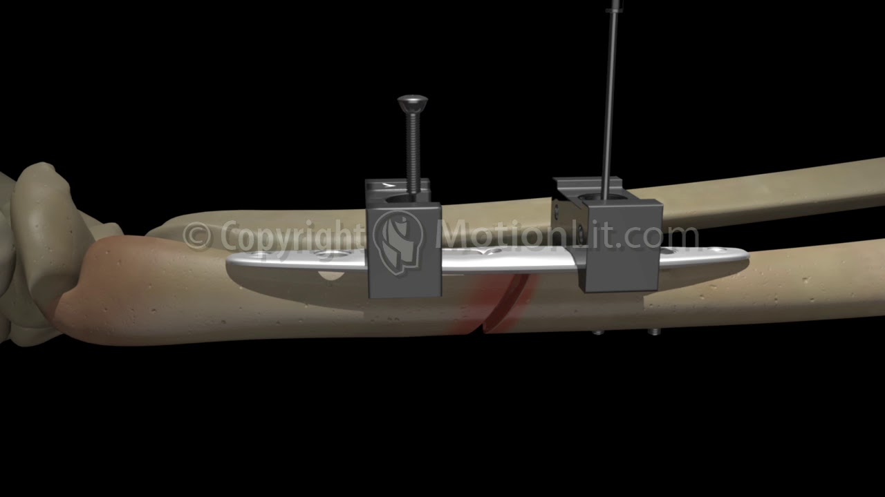 Right Arm Surgery YouTube