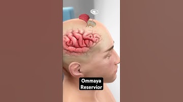 Injecting medicine directly into the brain (3D Animation)