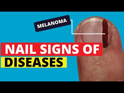 Video: Toenail-melanom Eller Svamp: Diagnose, årsager Og Behandling