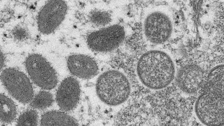 New evidence shows possible monkeypox spread in the US