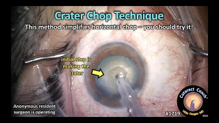 CataractCoach™1719: crater chop technique